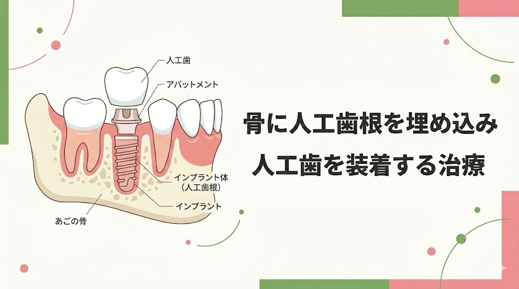 インプラントとは